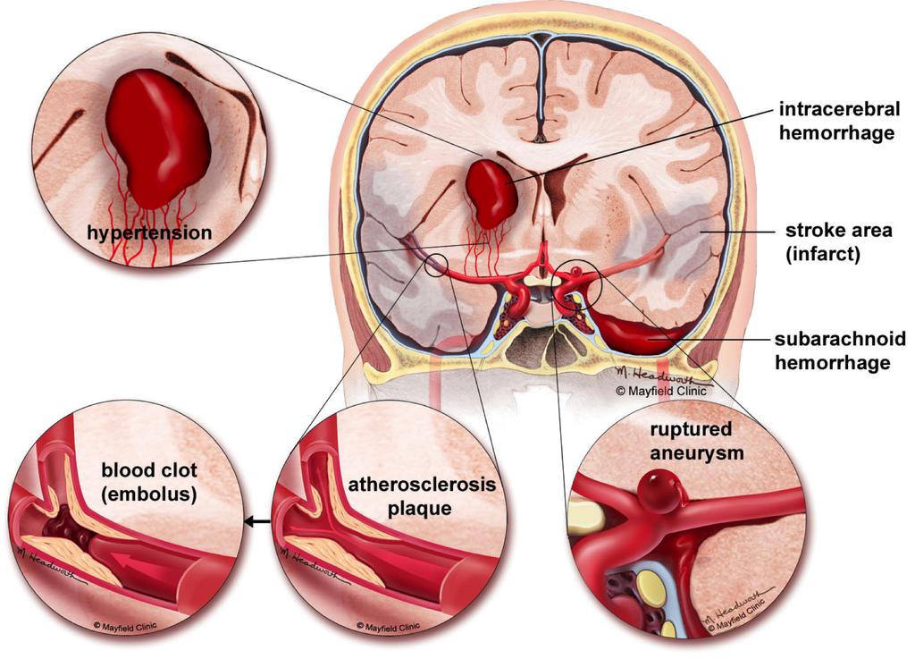 2 3 Figure 2. Types of stroke. D. Intracerebral hemorrage: Hypertension causes tiny arteries within the brain tissue to rupture. C.