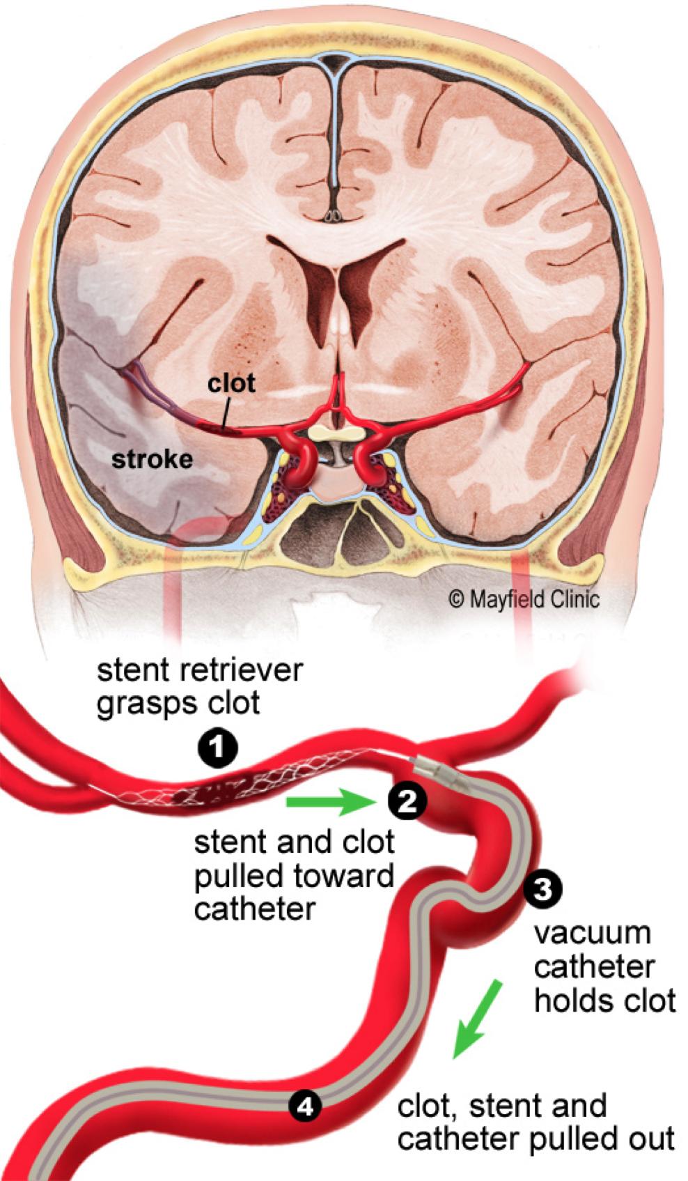 6 7 Hemorrhagic stroke treatment focuses on stopping the bleeding.