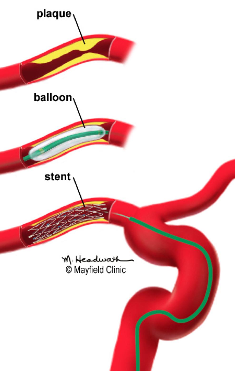 8 9 Angioplasty Angioplasty is used to open blood vessels narrowed or blocked by plaque build-up in atherosclerosis. A neuro-interventionalist performs it during an angiogram.