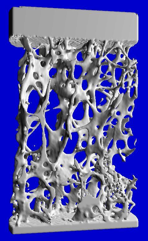 NIH Definition of Osteoporosis Osteoporosis is a systemic skeletal disorder characterized by compromised bone strength predisposing a