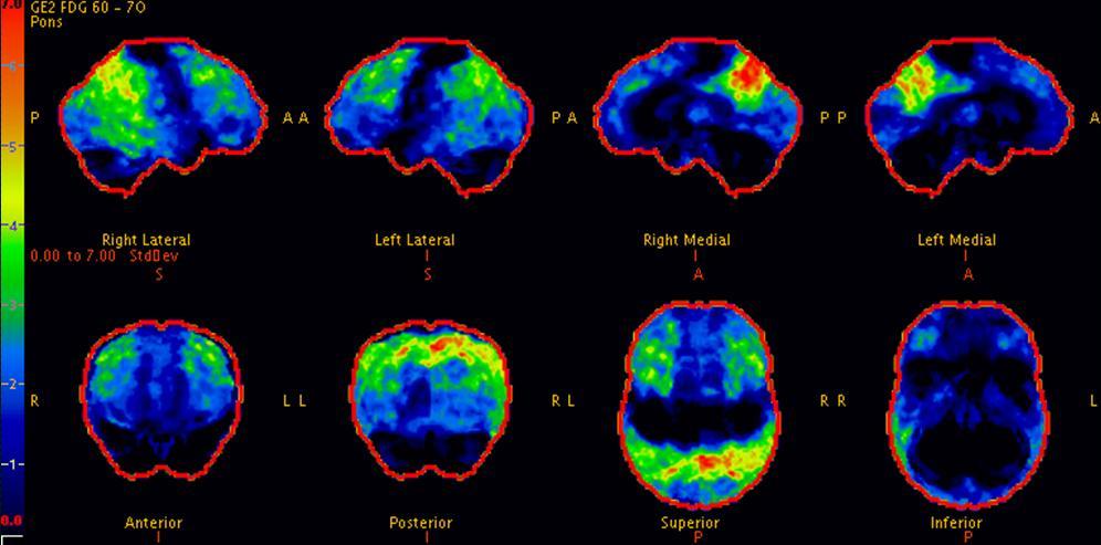 Neuroimaging Features FDG-PET Kantarci et al, Neurobiol Aging