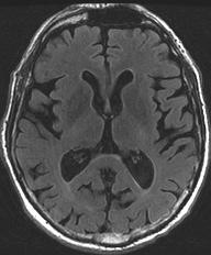 Neuroimaging Features - DaTscan caudate Ioflupane putamen DaTscan - meaures
