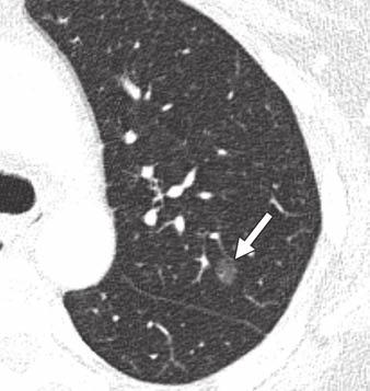 Management of Lung denocarcinoma TLE 2: Common Lesions Manifesting as Ground- Glass Nodules (GGNs) Type of GGN Transient Persistent Lesion Inflammatory Focal hemorrhage Focal edema Focal fibrosis