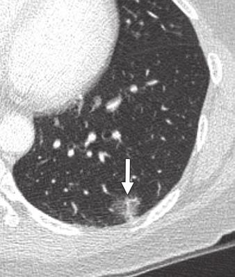 Management of Lung denocarcinoma In a phantom study by Lee et al.