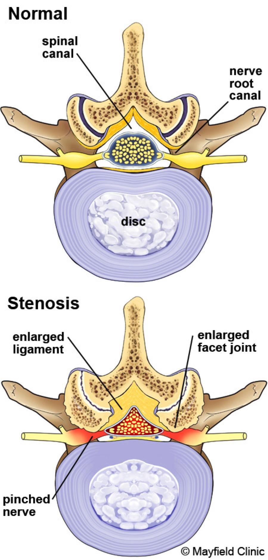 1 Spinal Stenosis Overview Spinal stenosis is the narrowing of the bony space (canals) through which the nerves and spinal cord pass.