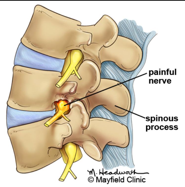6 7 Spinal decompression (laminectomy): While under general anesthesia, an incision is made in the middle of the back. The spinal muscles are moved aside to expose the bony vertebra.