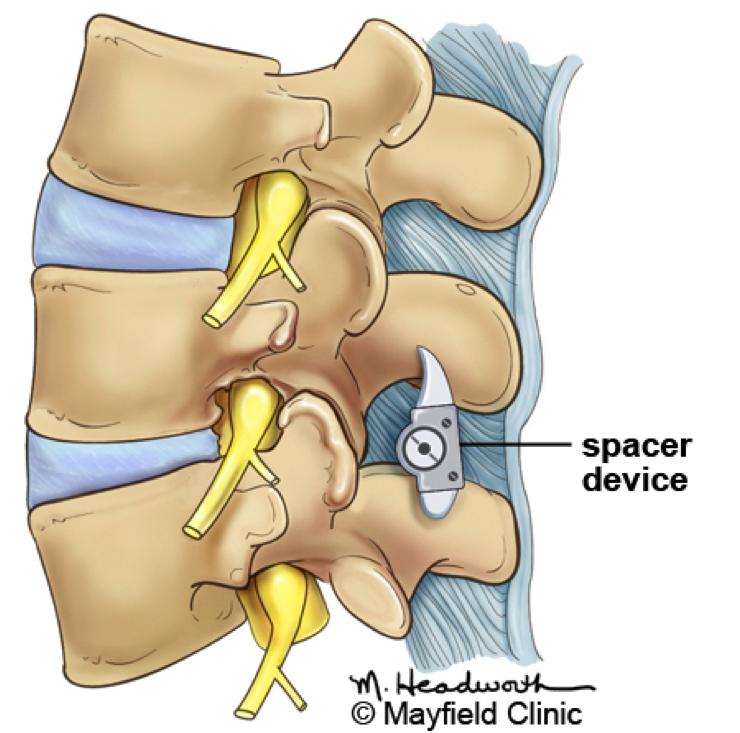 The overgrown facet joints, located directly over the nerve roots, may be trimmed to give more room for the spinal nerves to exit the spinal canal.