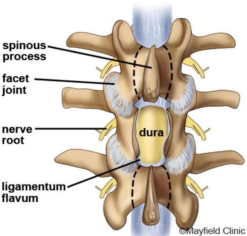 Spinal fusion: In patients with stenosis and spinal instability or slippage of one vertebra over another (spondylolisthesis), the surgeon may decide to permanently join together two or more vertebrae