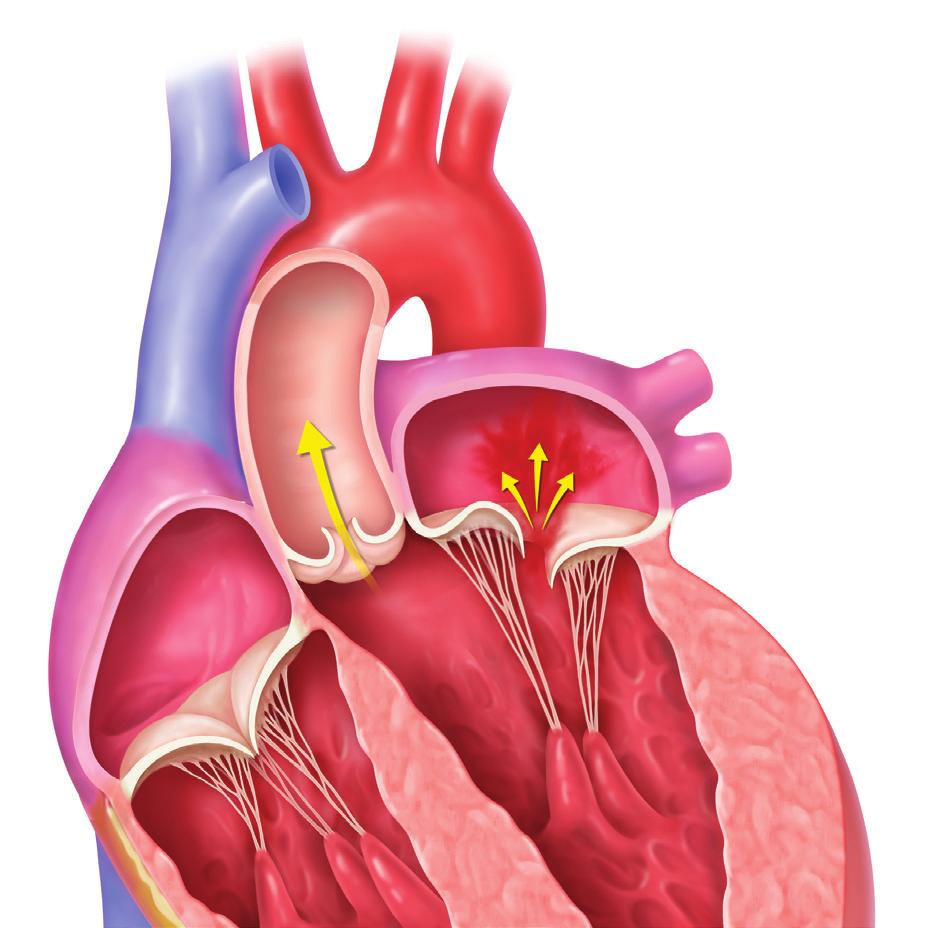 THE MITRAL VALVE AND MR Describe the location of the mitral valve and how the leaflets function Explain what happens when the mitral valve is damaged and define mitral regurgitation The Mitral Valve