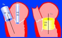 Quantitative Assessment of MR - Volumetric Flow Measure SV in 2 regions, one of which includes the regurgitant volume. Difference b/n these two SVs is the regurgitant volume through the valve.