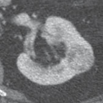 criteria: resection of histopathologically proven ccrcc at the institution; CT examination of the abdomen performed less than 1 days before surgery, with application of an IV contrast agent and at