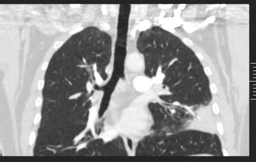 Mr H, Coronal CT with IV contrast 5.6 x 2.