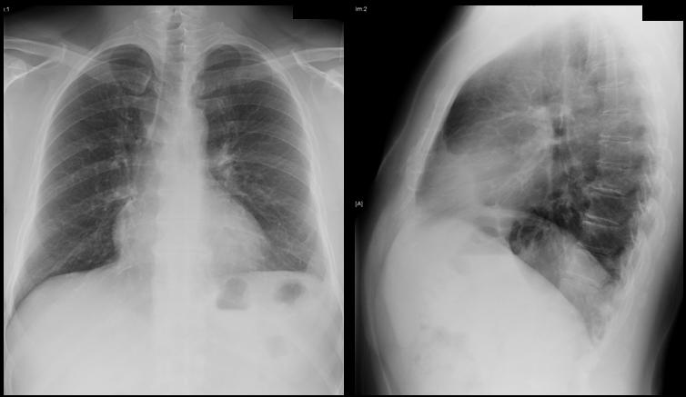 Mr. H, Follow-up Chest Radiographs (2 months later) PACS, BIDMC PACS, BIDMC
