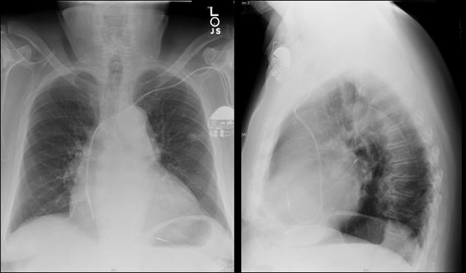 Mr. G, Follow-up Chest Radiographs