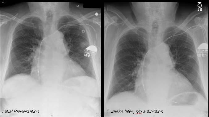 Mr. G, Initial and Follow-up Chest Radiographs Initial Presentation 2 weeks later, s/p antibiotics PACS,