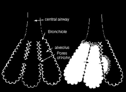 Relevant Anatomy Pores of Kohn: openings in the alveolar walls connecting adjacent alveolar lumens Canals of Lambert: connections between terminal bronchioles and