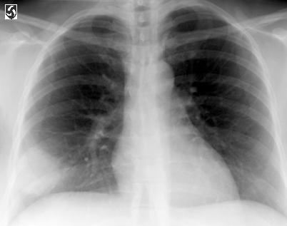 41-year-old female nonsmoker with fever and