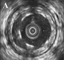 Independent predictors of postprocedural incomplete stent apposition (by IVUS of 339 lesions treated with DES) Incidence of incomplete