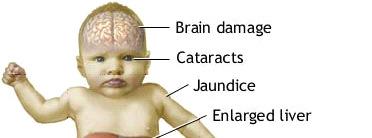 SIGNS AND SYMPTOMS At birth: Jaundice after milk consumption Feeding