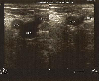 Key Sonographic Finding: Venous Compression The key ultrasonographic finding in excluding venous clot is the complete compressibility of the vein with downward pressure of the ultrasound probe (image