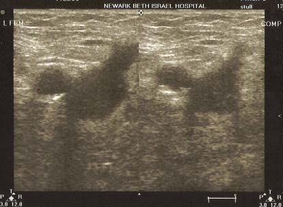 However, with thrombosis and lumen obstruction, downward probe pressure will fail to compress the vein (image 2 and 3).