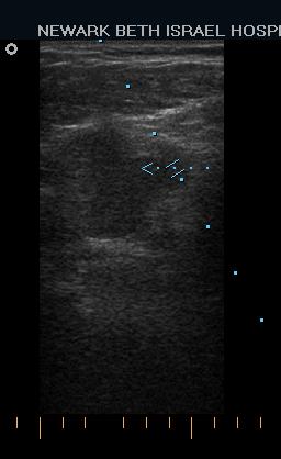 Image 4, 5: Echogenic clot in the Common Femoral Vein (CFV) and in the Poplieal Vein (PV). Note Common Femoral Artery (CFA) and Popliteal Artery (PA). What about color flow imaging?