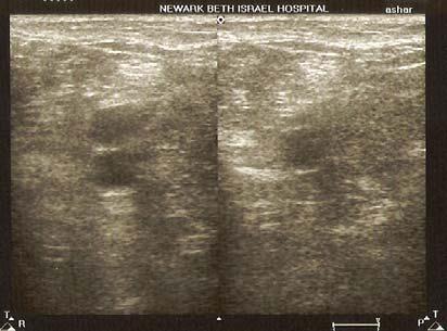 PA PV PV (collapsed) PA Image 13: Normal Popliteal Artery (PA) and vein (PV) on the left. With compression, the popliteal vein collapses entirely.