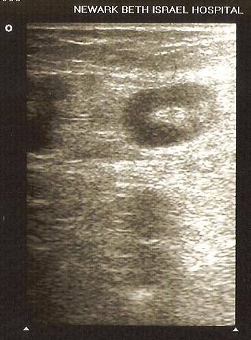 was unnecessary. If the ED ultrasound is negative and the possibility of thrombus likely, tell the patient that a repeat ultrasound in a week should be performed.