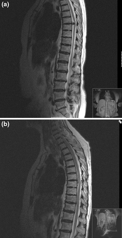 Fig. 3 a Pre-operative sagittal T2-weighted MR image of patient no. 2 showing a thoracic disc herniation at the level T6 T7. b Postoperative sagittal T2-weighted MR image of patient no.