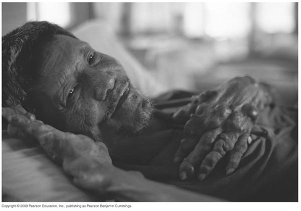 Bacterial Diseases of the Nervous System Hansen s Disease (Leprosy) Signs and symptoms manifest in two forms Tuberculoid leprosy nonprogressive Lepromatous leprosy progressive tissue destruction