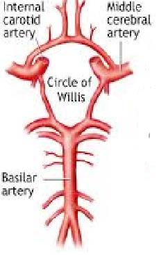 Posterior Cerebral Artery Midbrain Top of the Basilar syndrome o