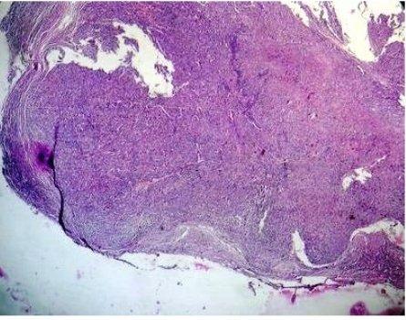 CASE REPORT Intravascular Epithelioid Haemangioma Of Temporal Artery: A Diagnostic Difficulty PAI K, GUPTA A.