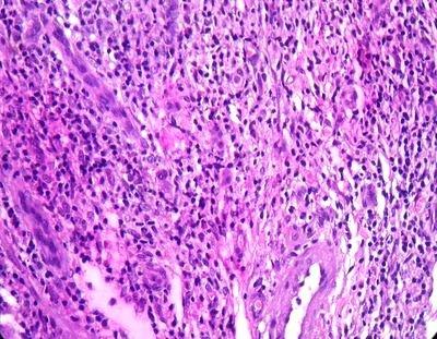 Table/Fig 2 Intravascular lesion shows proliferation of blood vessels and diffuse lymphocytic infiltrate 400X,H&E The histopathologic examination of the specimen showed cross-section of vessel,