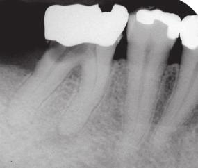 Treatment Options for the Compromised Tooth Nonendodontically Treated