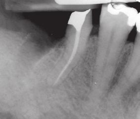 Tooth Structure Favorable: >1.5 mm ferrule Questionable: 1.0 to 1.
