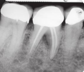 periodontium Normal probing depths (3mm or less) The tooth exhibits pulp