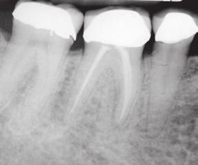 Questionable: Moderate periodontal disease An isolated periodontal