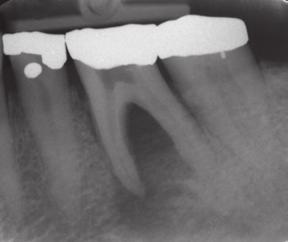 Unfavorable: Advanced periodontal disease Generalized periodontal probing
