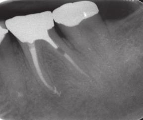 defect Tooth #19 with extensive osseous destruction; there is sulcular
