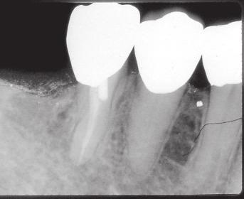 resection Unfavorable: Canal calcification, complex canal and root