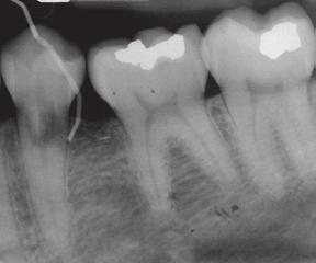 Treatment Options for the Compromised Tooth