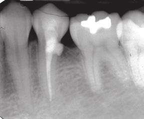External Resorption Favorable: Minimal loss of tooth