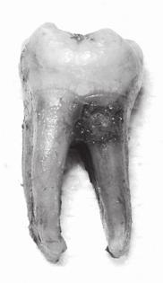 maxillary right central incisor; there is a peridontal