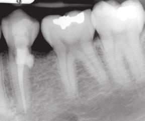 lesion is accessible for repair Apical root resorption
