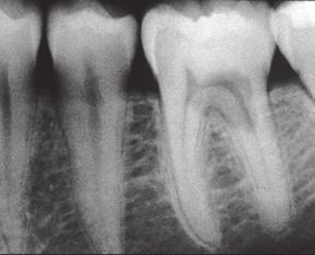 surgically External resorption with sinus tract, with 3 mm