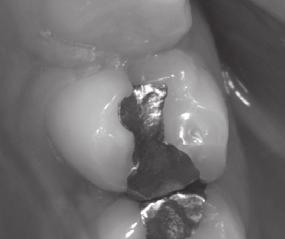 Tooth Fractures Cracked Tooth Favorable: Fracture in enamel only (crack line) or fracture in enamel