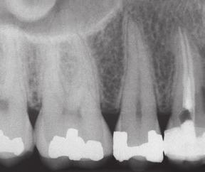 associated periodontal probing defect The pulp may be vital requiring only a crown If pulp has