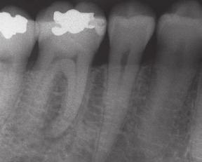 lesion of endodontic origin Unfavorable: Fracture line extends apical to the cemento-enamel junction