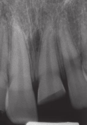 fracture of enamel or enamel and dentin extending onto the root below the crestal bone; compromised