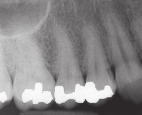 canal treatment; prognosis favorable Clinical Photograph RCT *These images were published in The